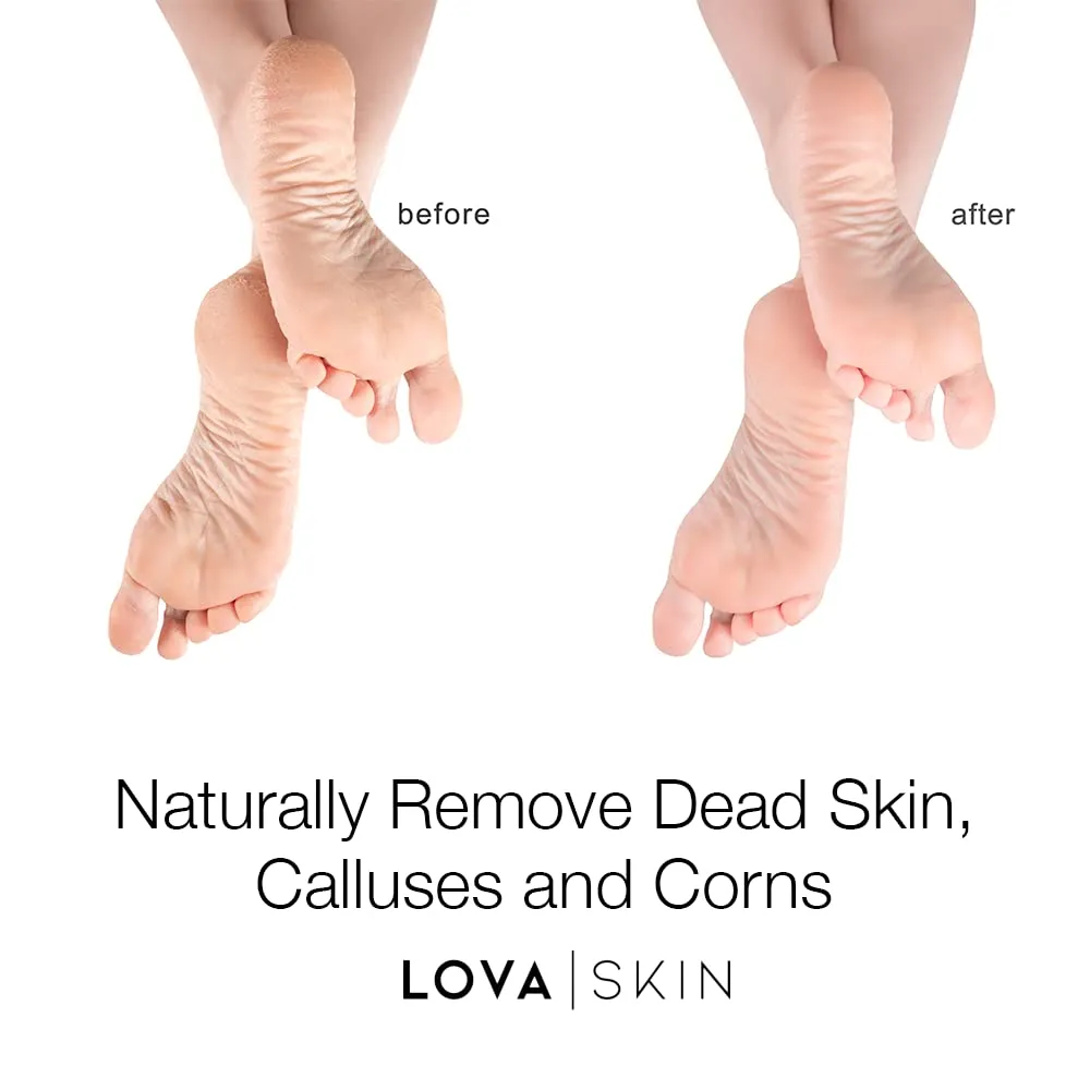 Lovaskin Instant Foot Peel Spray | Exfoliating Treatment for Corns, Calluses & Cracked Feet | Spa-Quality Pedicure & Foot Care Spray for Soft, Smooth, and Healthy Feet