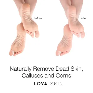 Lovaskin Instant Foot Peel Spray | Exfoliating Treatment for Corns, Calluses & Cracked Feet | Spa-Quality Pedicure & Foot Care Spray for Soft, Smooth, and Healthy Feet